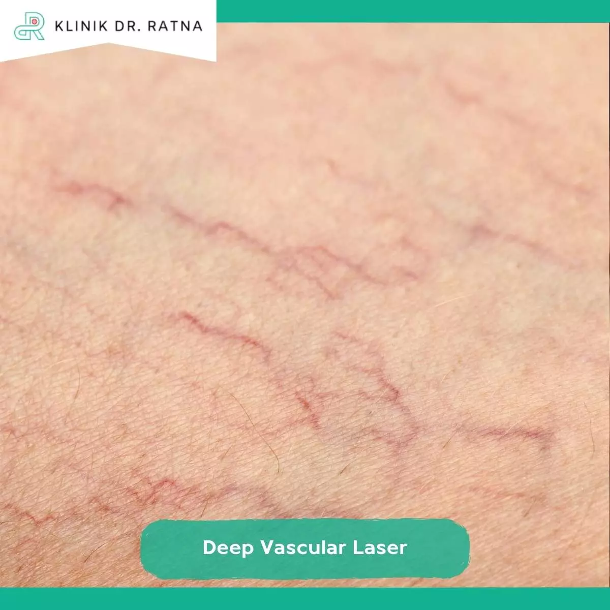 Apa Itu Spider Vein dan Mengapa Sering Muncul di Wajah