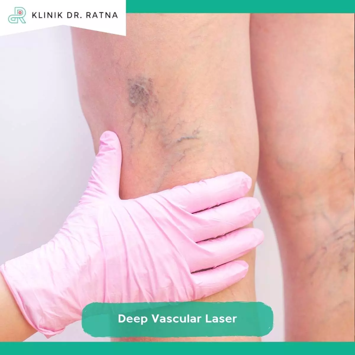 Keuntungan Treatment Spider Vein Rutin di Klinik dr. Ratna