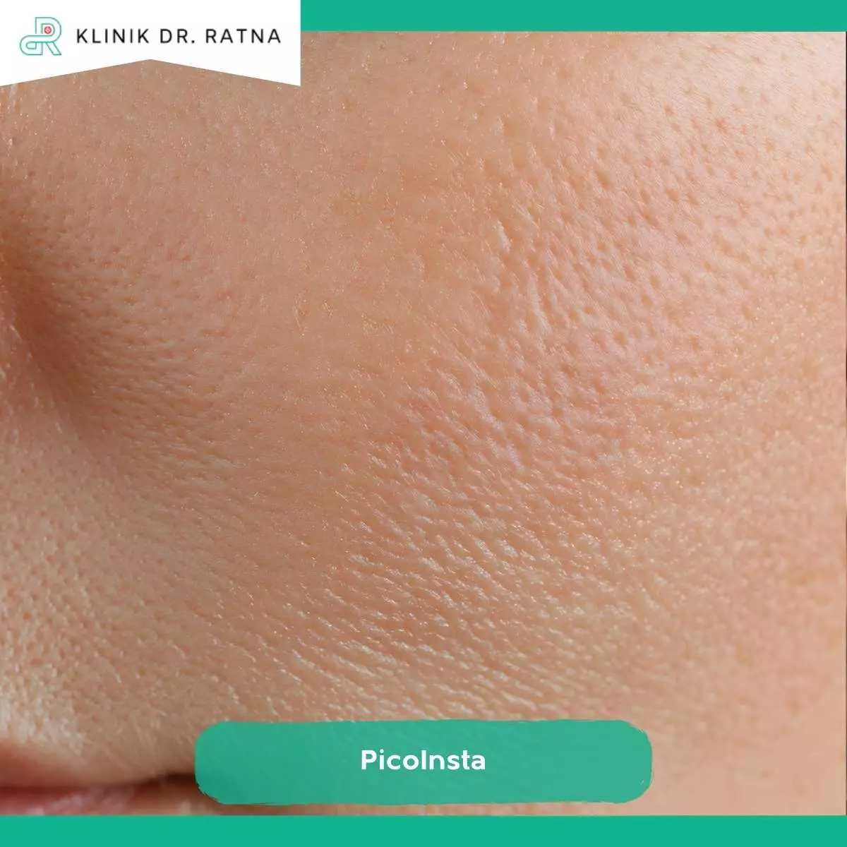 Perbedaan PicoInsta dengan Treatment Laser Lain
