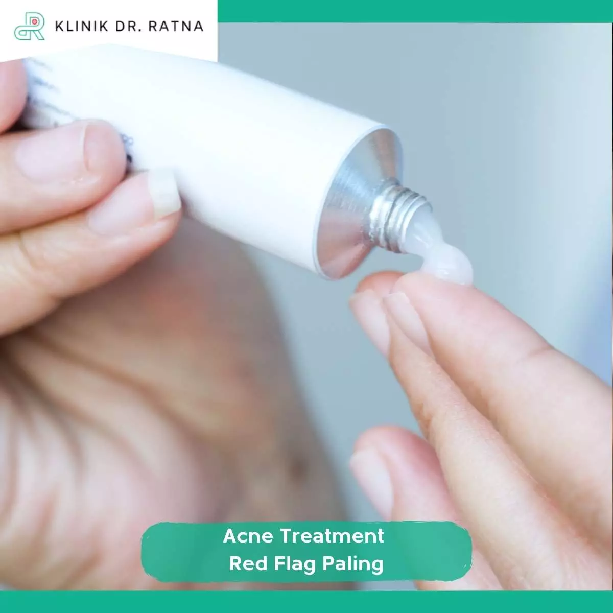 Cara Mengenali Acne Treatment yang Aman dan Tepat