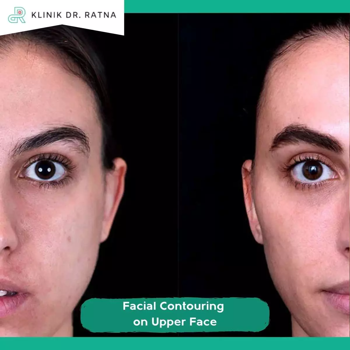 Apa Itu Facial Contouring on Upper Face?