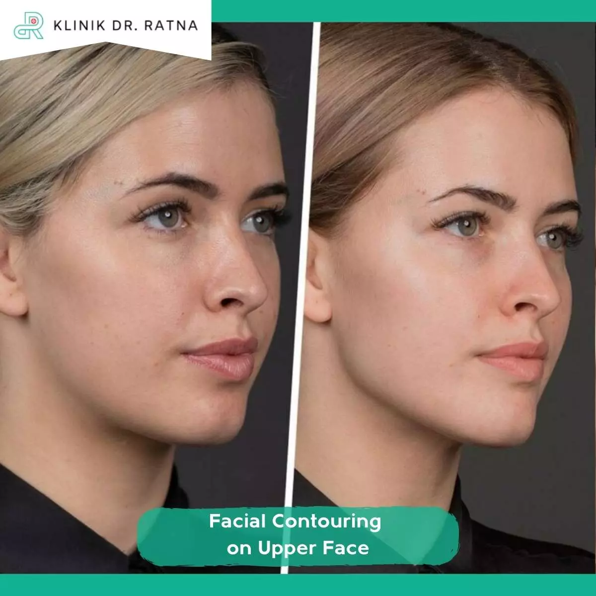 Keunggulan Facial Contouring on Upper Face Dibanding Operasi