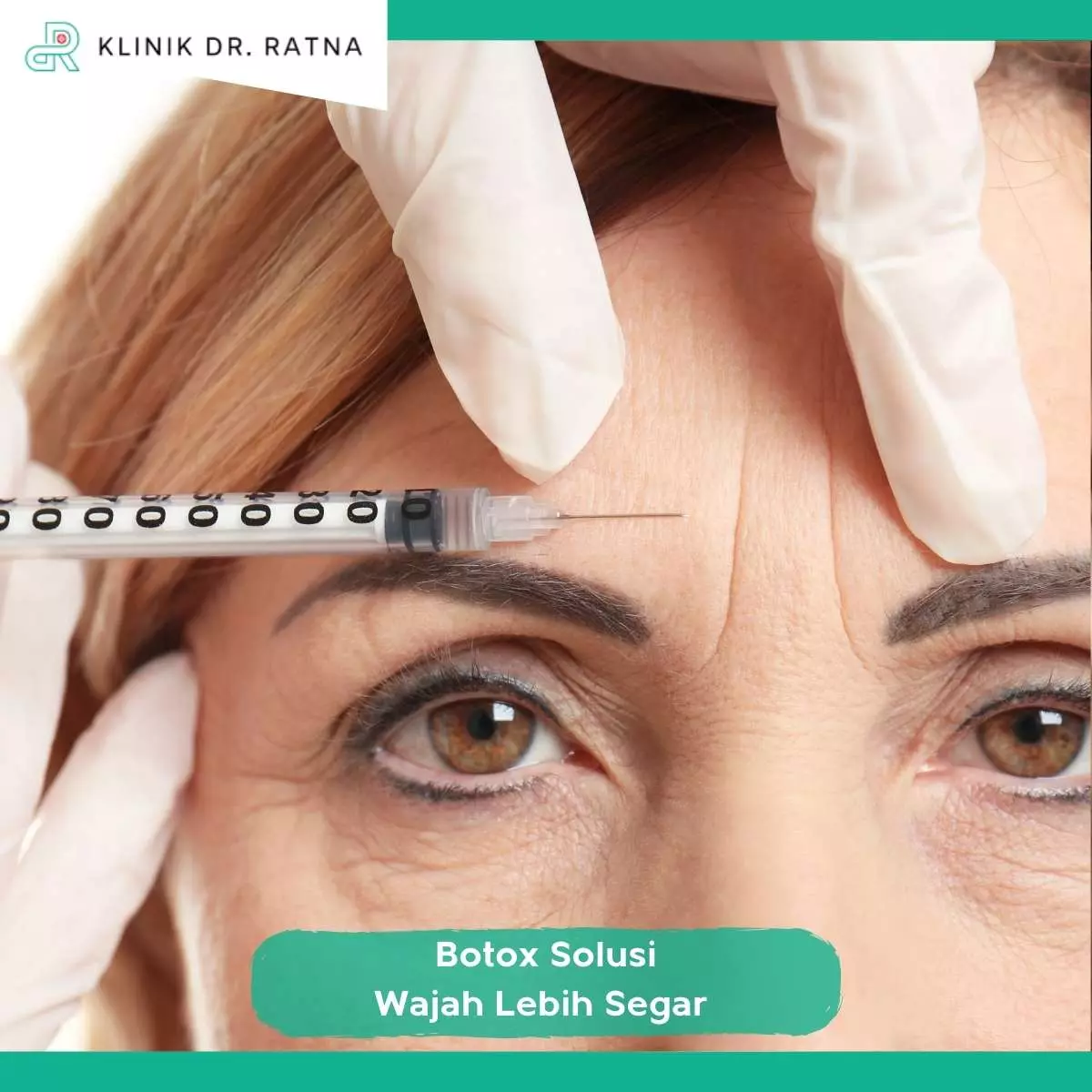 Manfaat Botox Wajah untuk Tampilan Lebih Segar