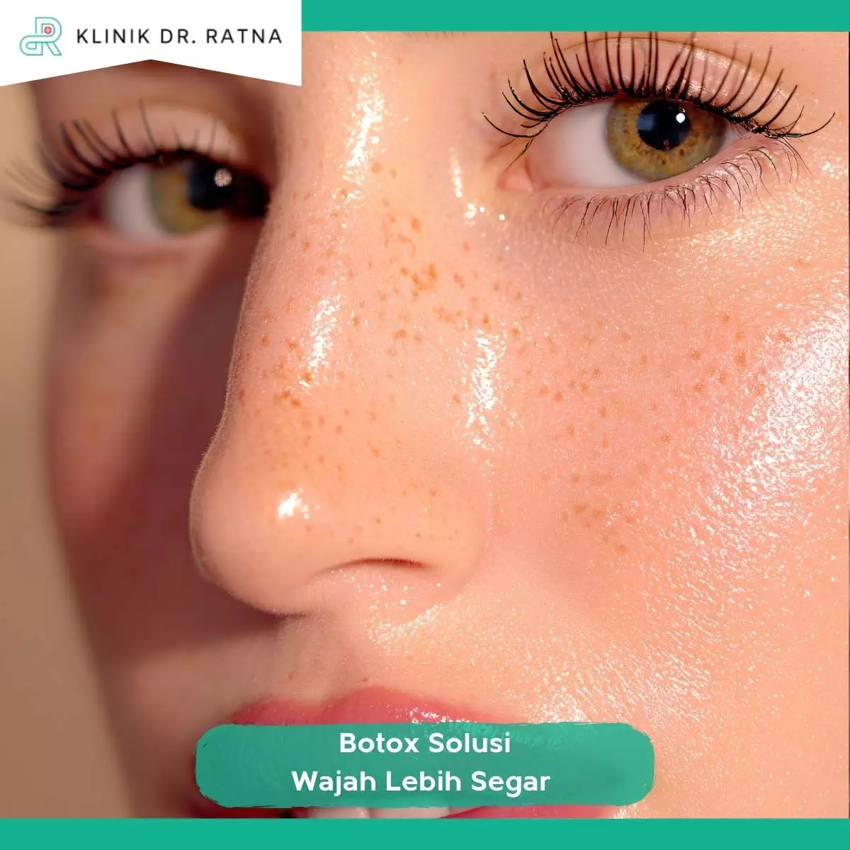 Siapa yang Cocok Melakukan Botox Wajah?