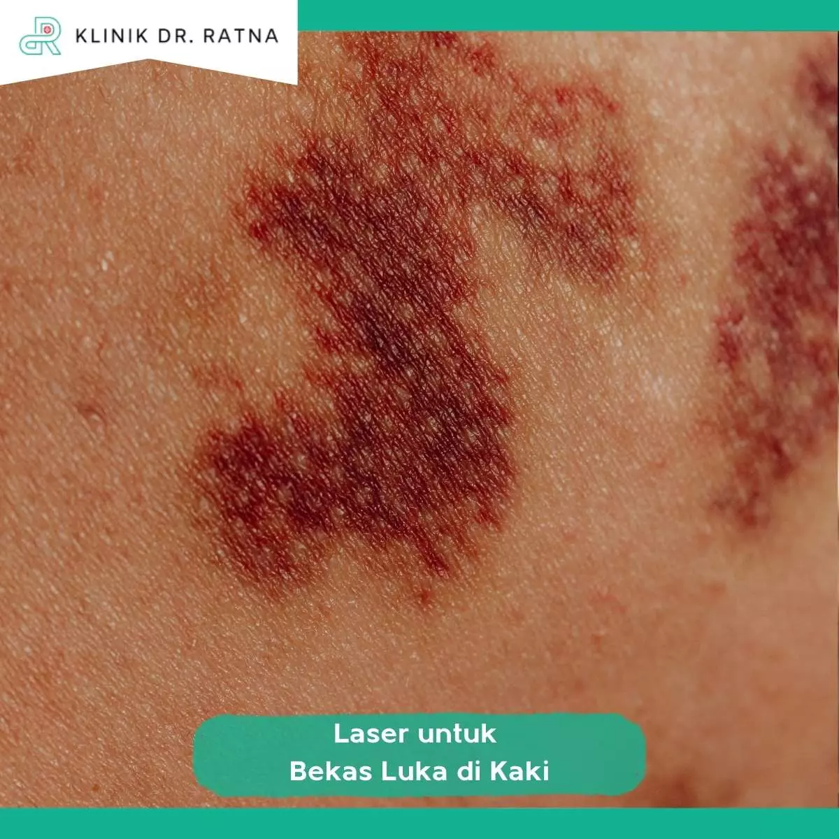 Kenapa Bekas Luka di Kaki Sulit Hilang