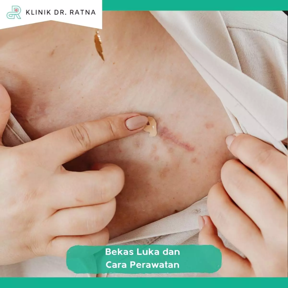 Kenali Jenis Bekas Luka dan Cara Perawatan yang Paling Tepat