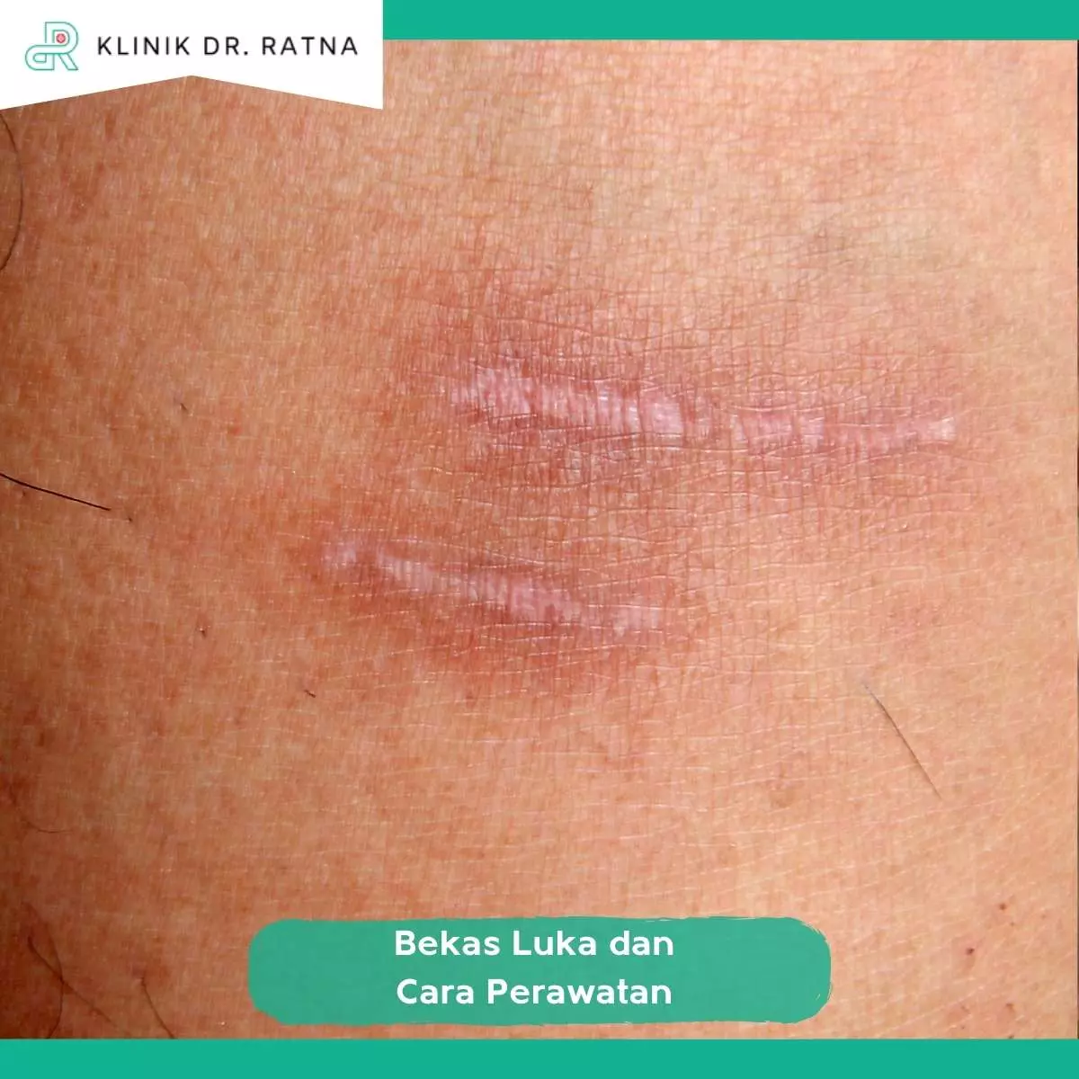 Tips Mencegah Bekas Luka Semakin Parah