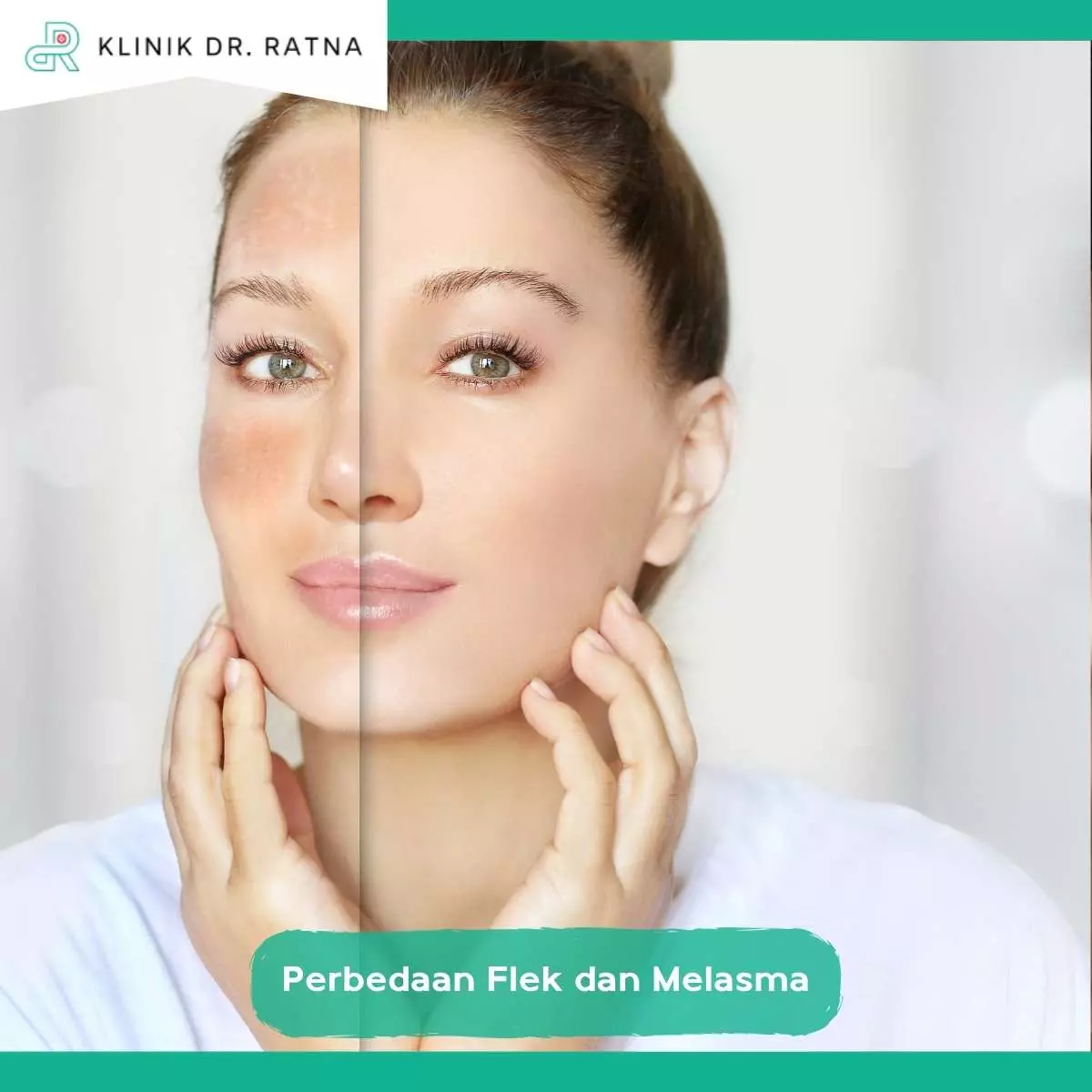 Faktor Penyebab Flek dan Melasma