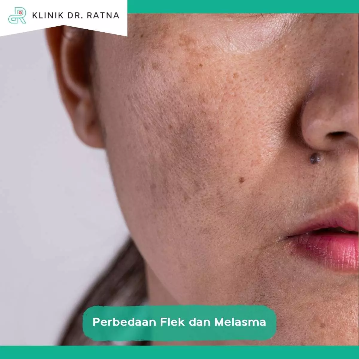Cara Mengatasi Flek Hitam Secara Efektif