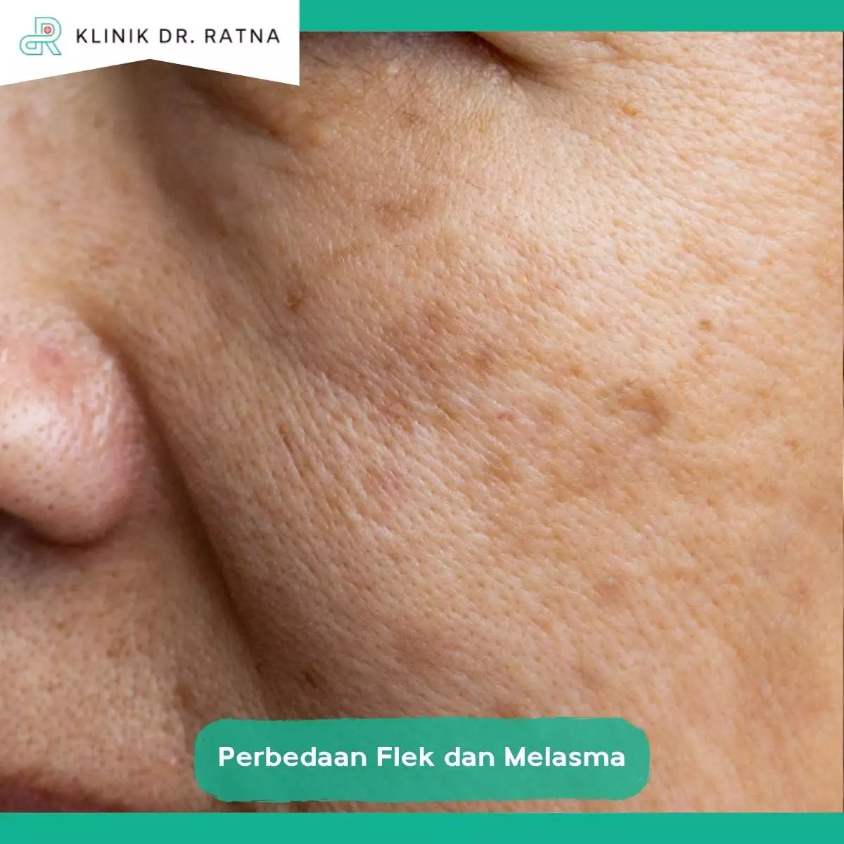 Solusi Perawatan Terbaik untuk Melasma