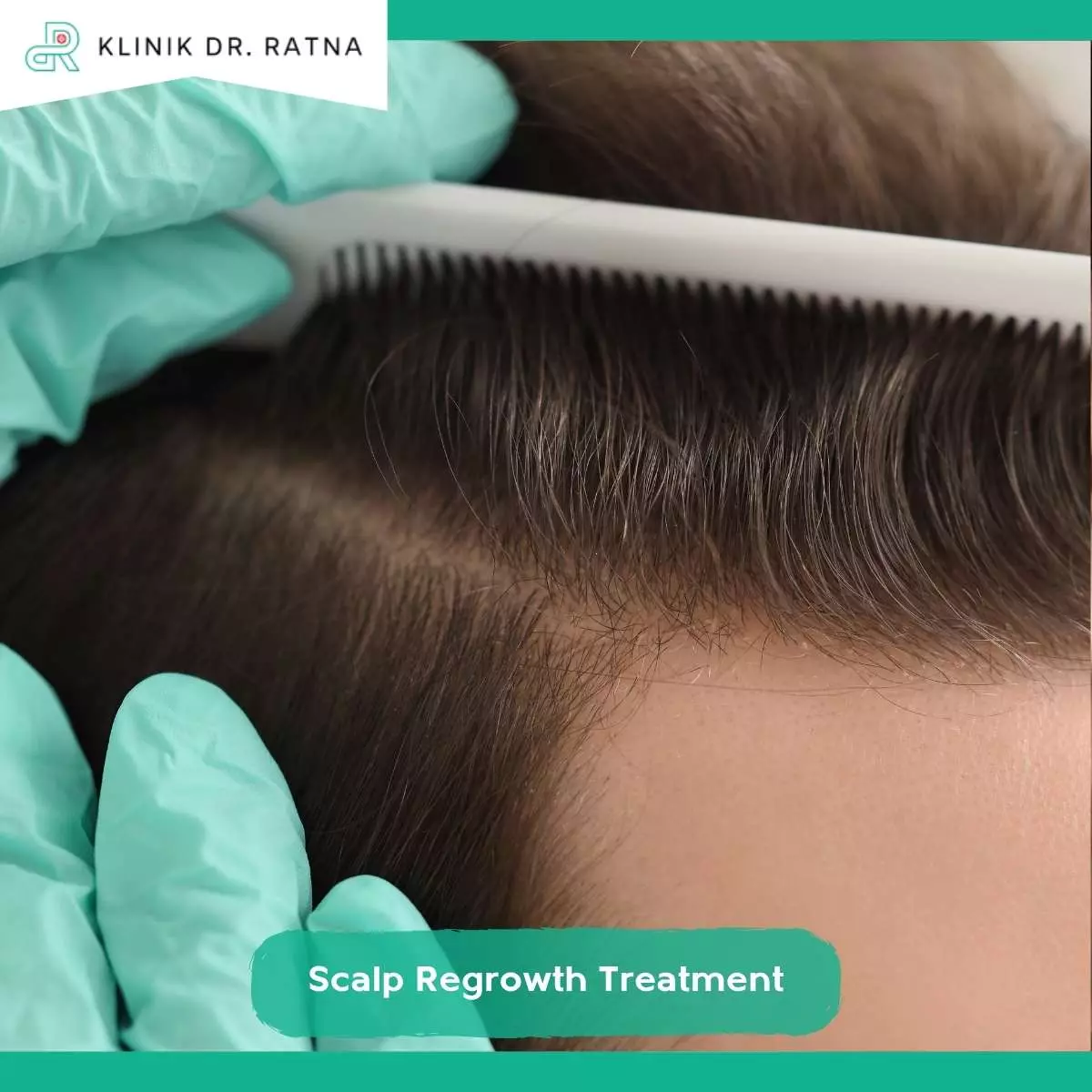 Apa Itu Scalp Regrowth Treatment?