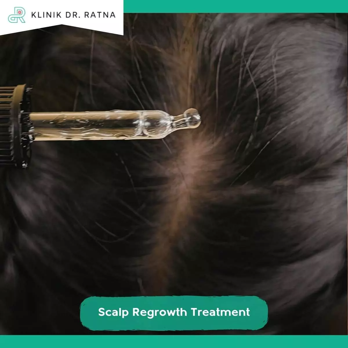 Tips Memaksimalkan Hasil Scalp Regrowth Treatment