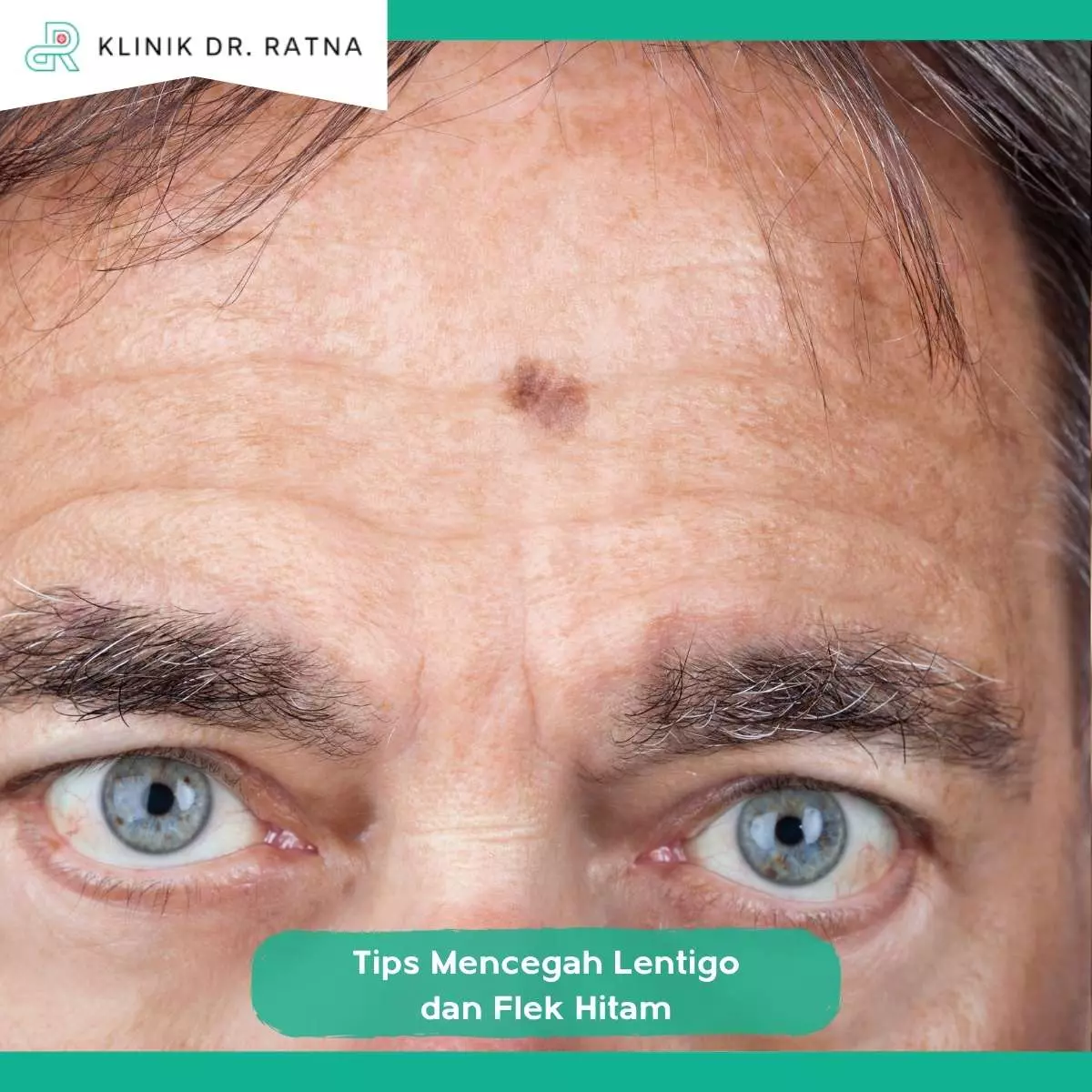 Tips Mencegah Lentigo dan Flek Hitam 