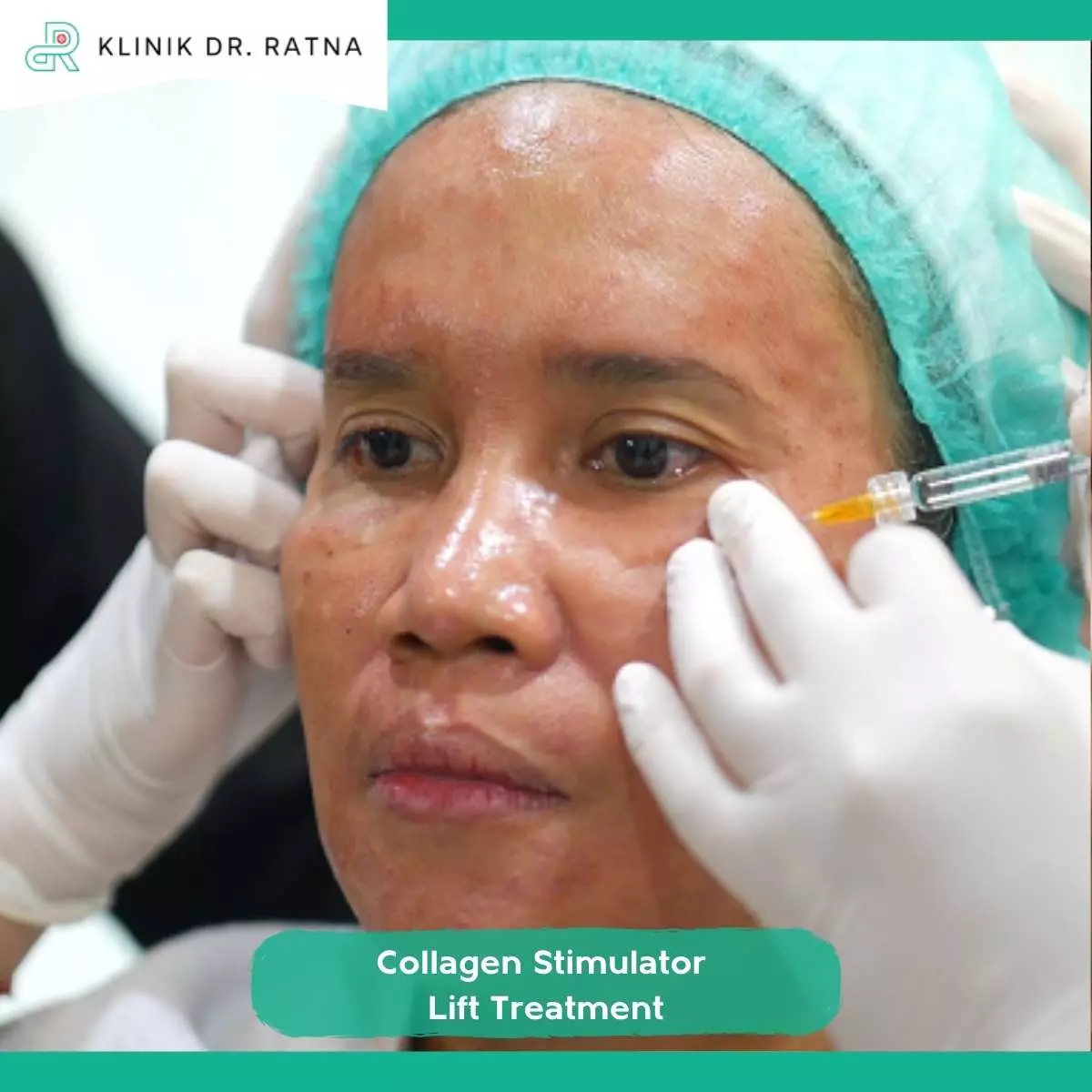 Tips Agar Hasil Collagen Stimulator Lebih Maksimal