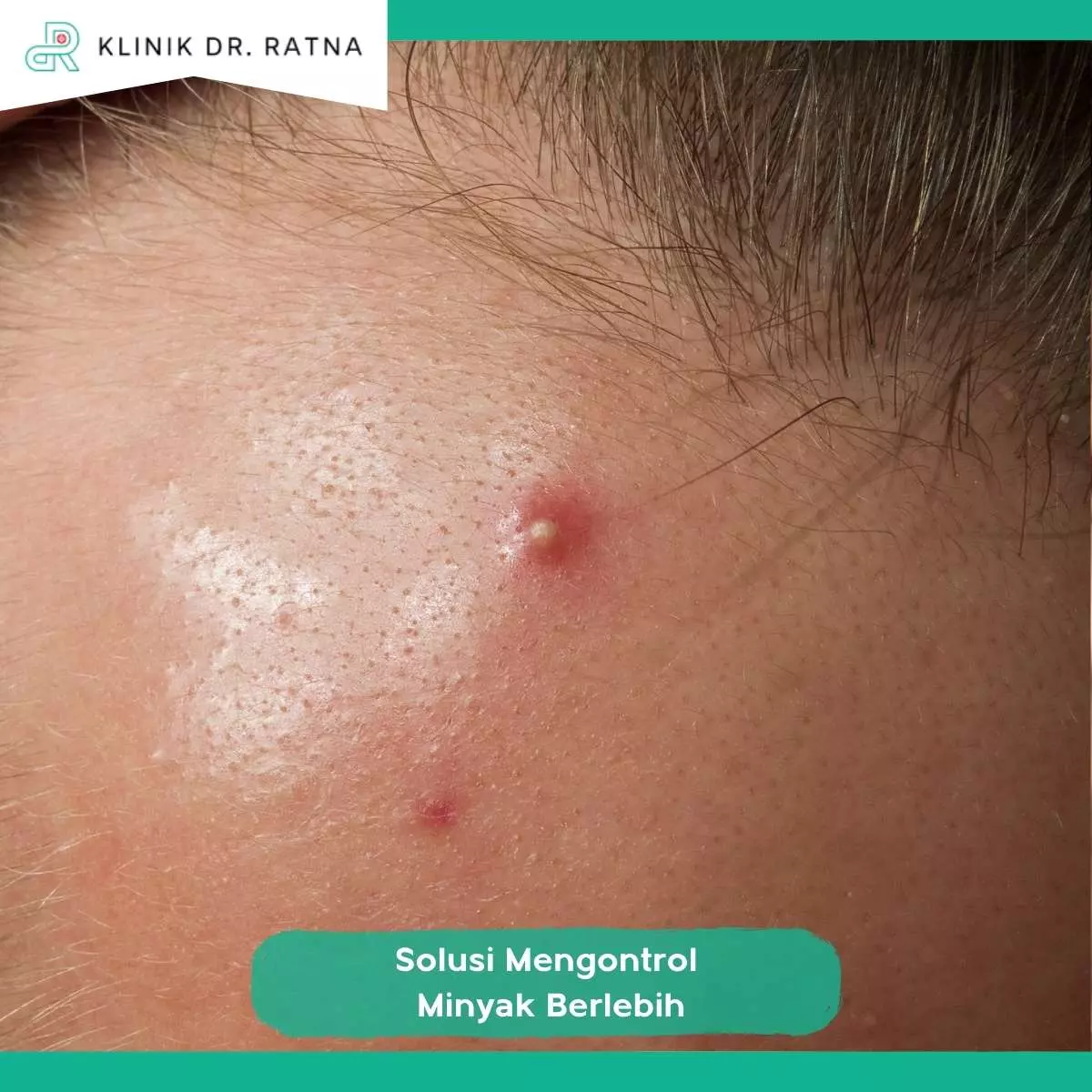 Apa Itu SP Sebum Correction?