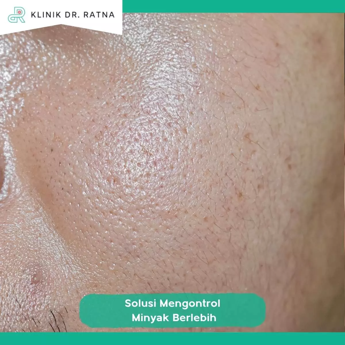 Keunggulan SP Sebum Correction Dibandingkan Perawatan Biasa