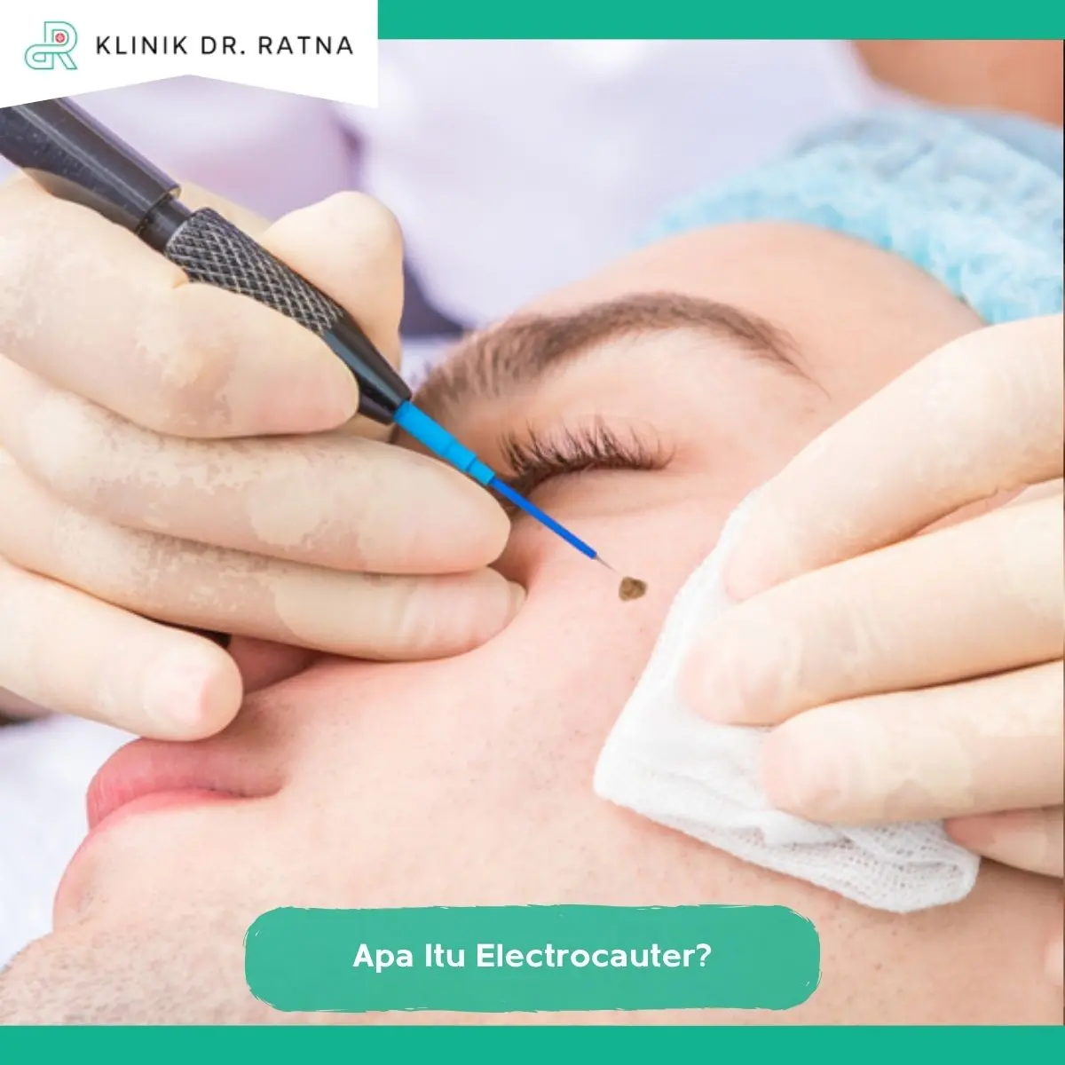 Apa Itu Electrocauter?