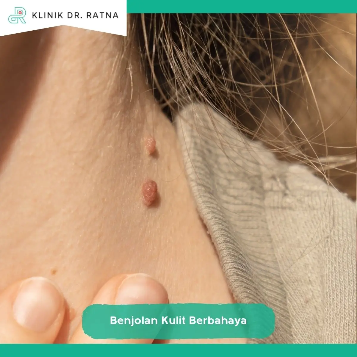 Kapan Benjolan Kulit Harus Diperiksa Dokter?