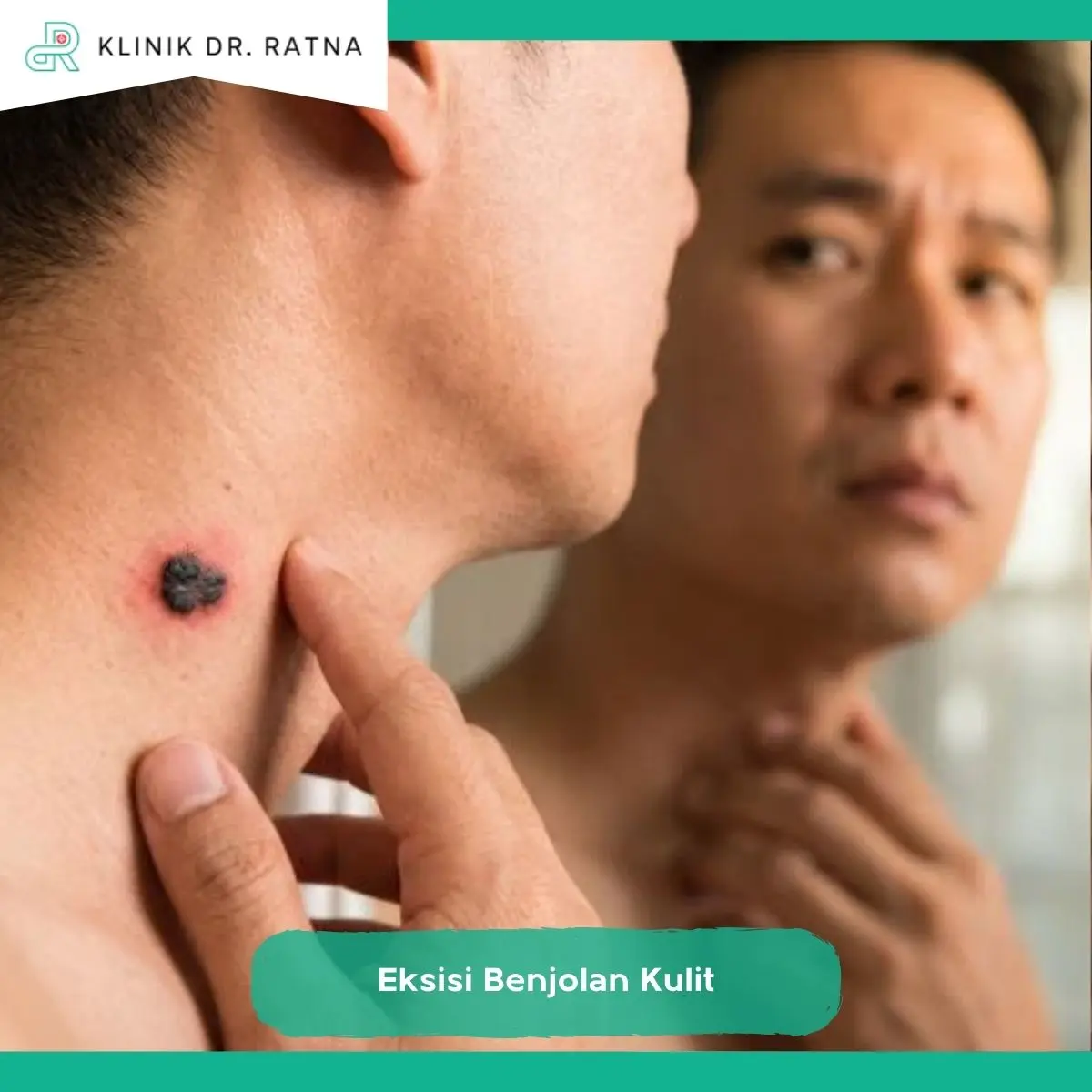 Apa yang Dimaksud dengan Eksisi Benjolan Kulit?