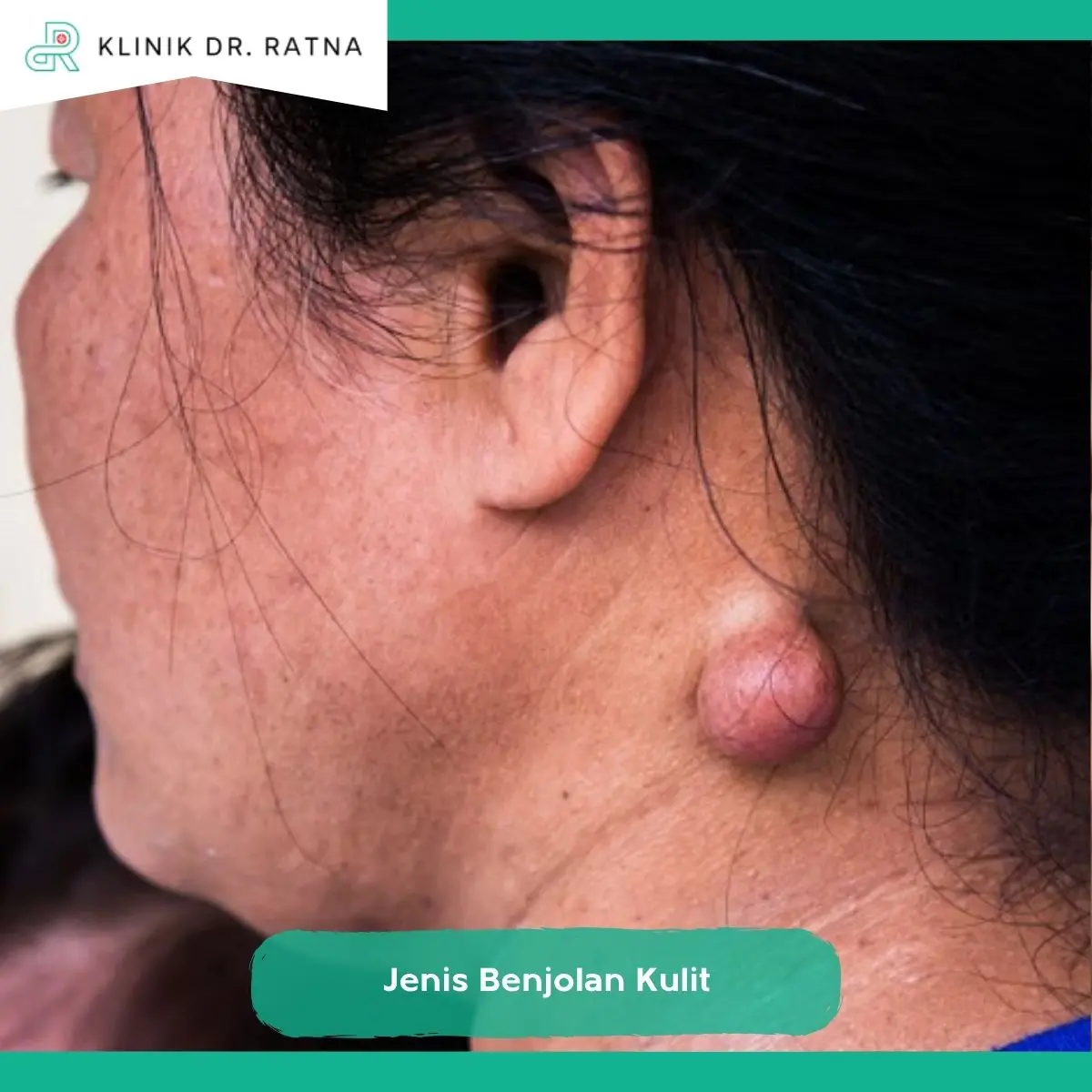 Benjolan yang Mungkin Memerlukan Eksisi