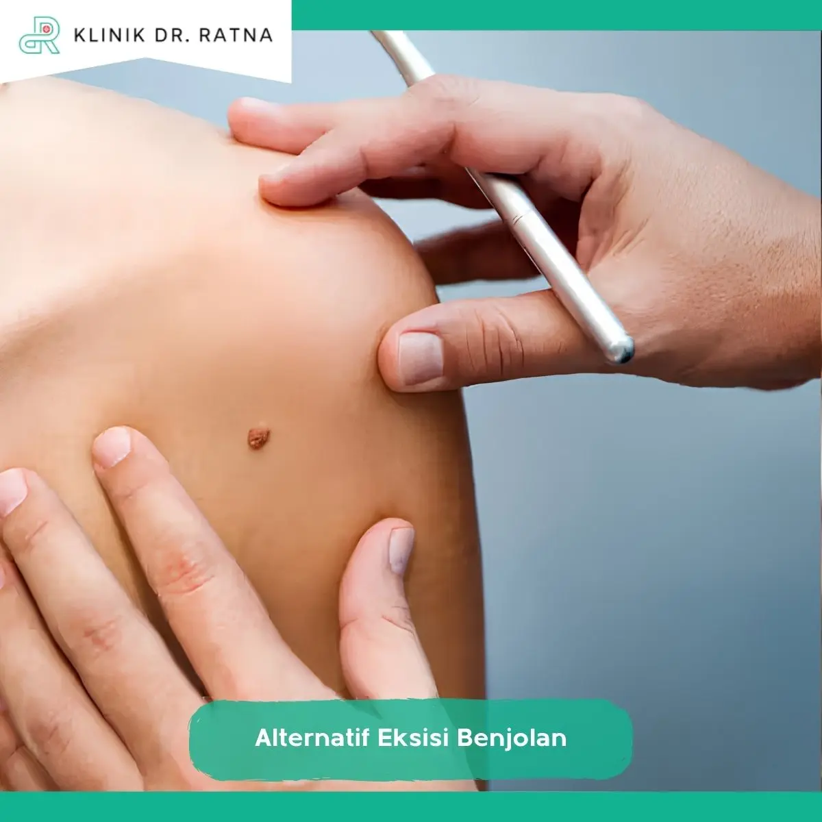 Kapan Eksisi Bukan Pilihan Utama?