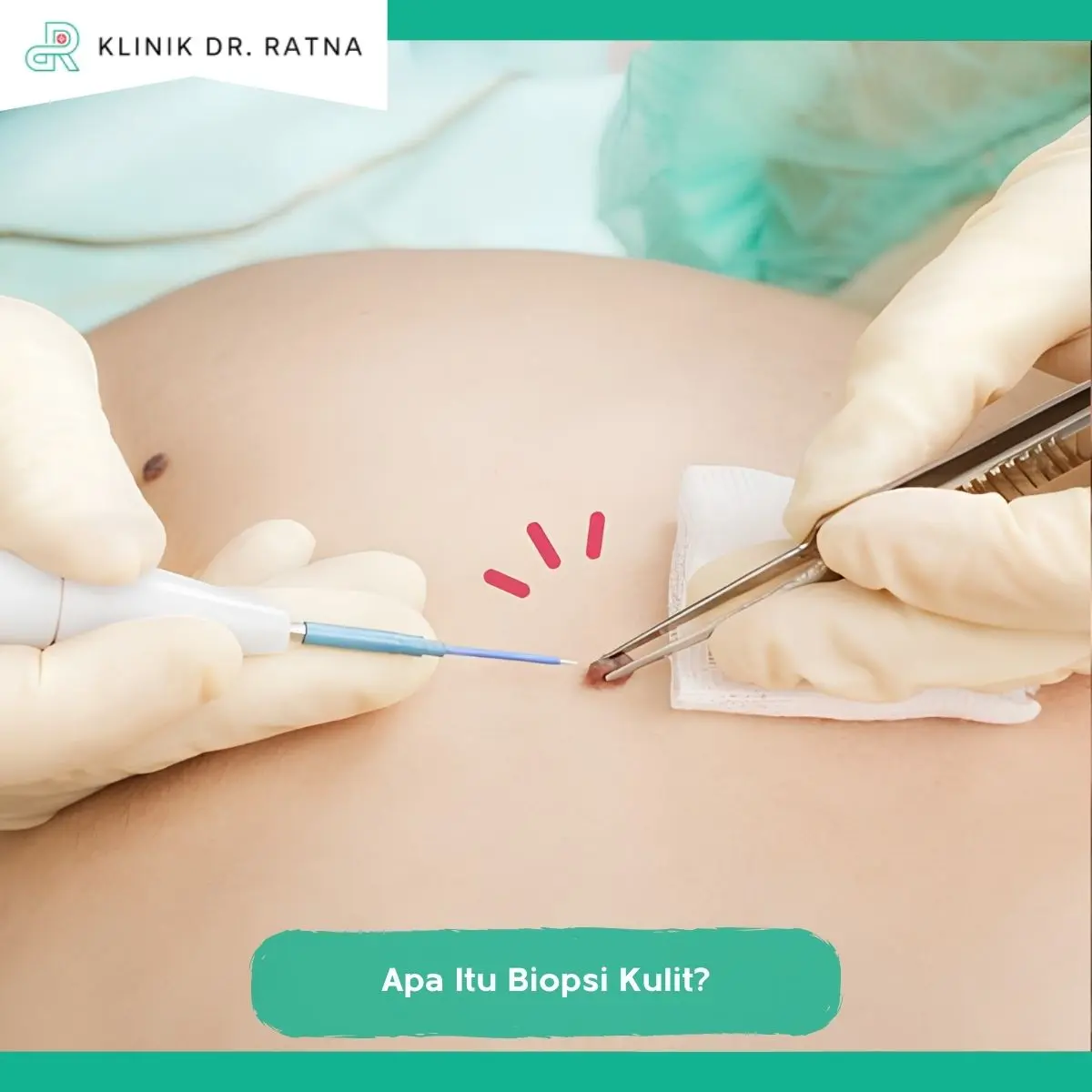 Apa Itu Biopsi Kulit?