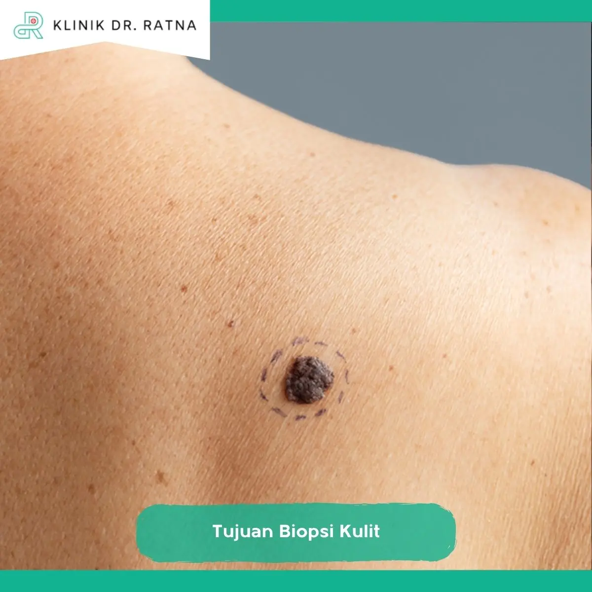 Tujuan Biopsi Kulit