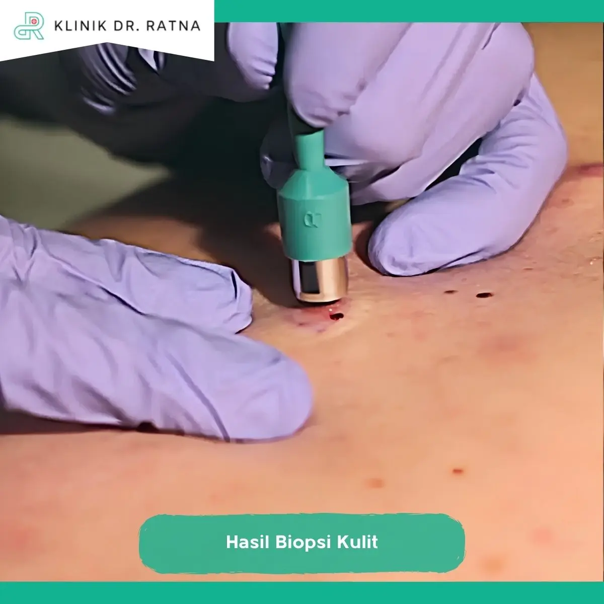 Cara Membaca Hasil Biopsi Kulit