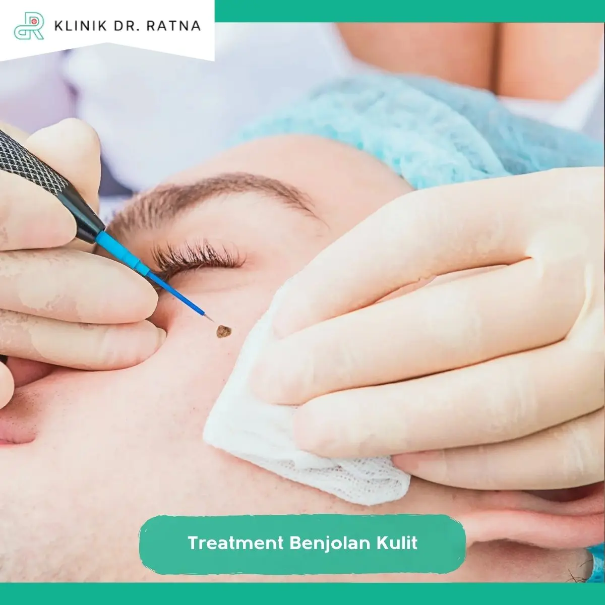 Treatment Benjolan Kulit di Klinik dr Ratna Surabaya