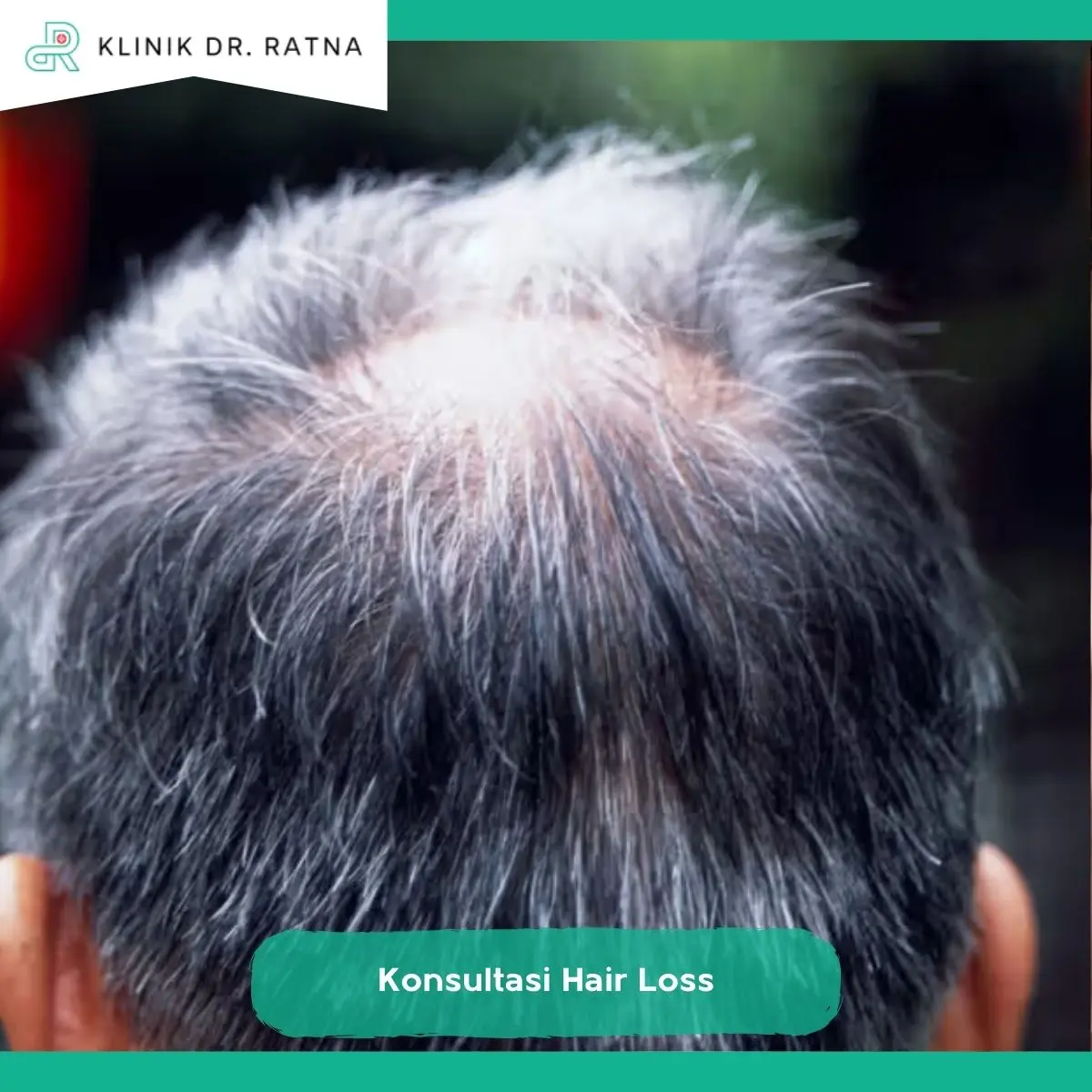 Konsultasi Hair Loss di Klinik dr Ratna Surabaya
