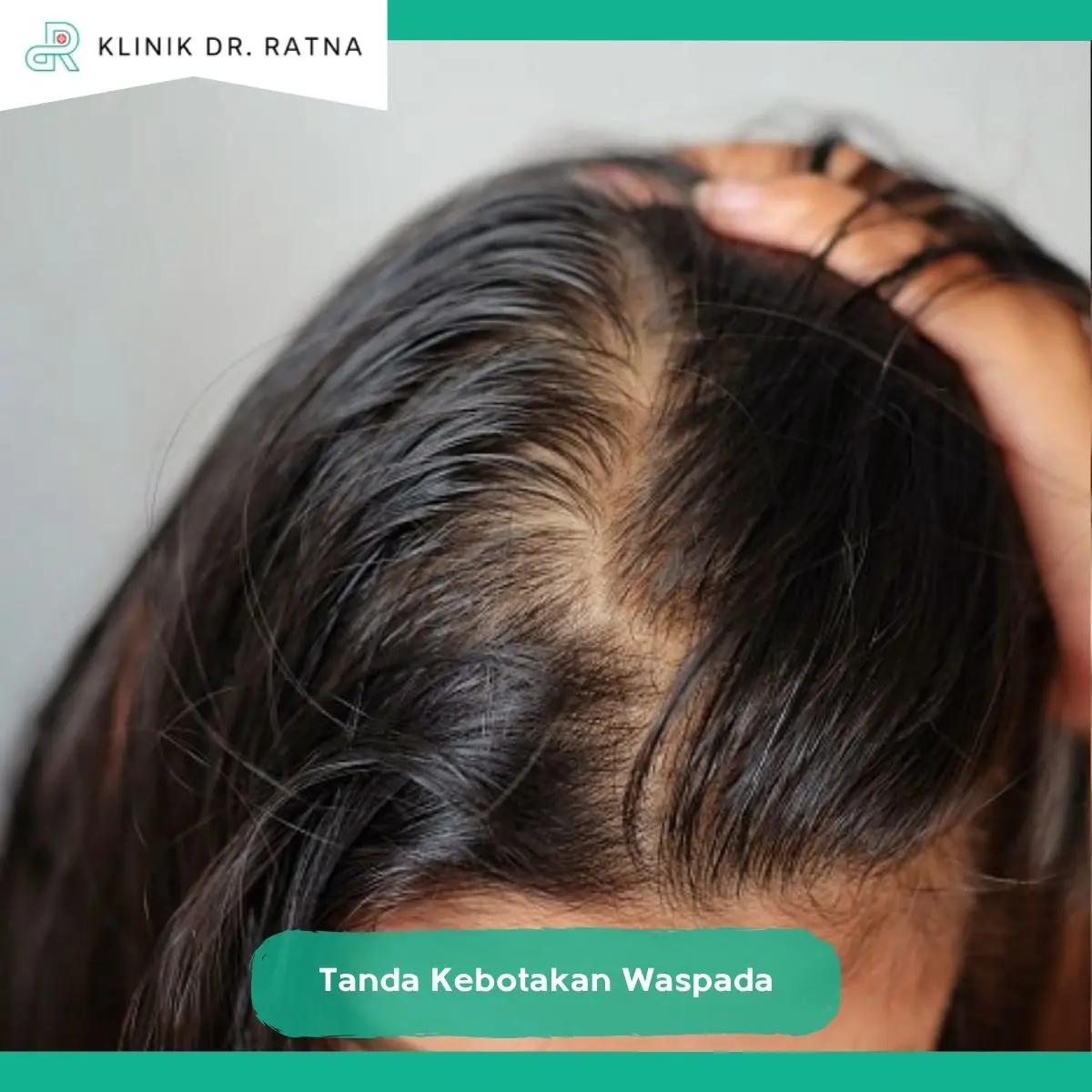 Tanda-Tanda Kebotakan yang Perlu Diwaspadai