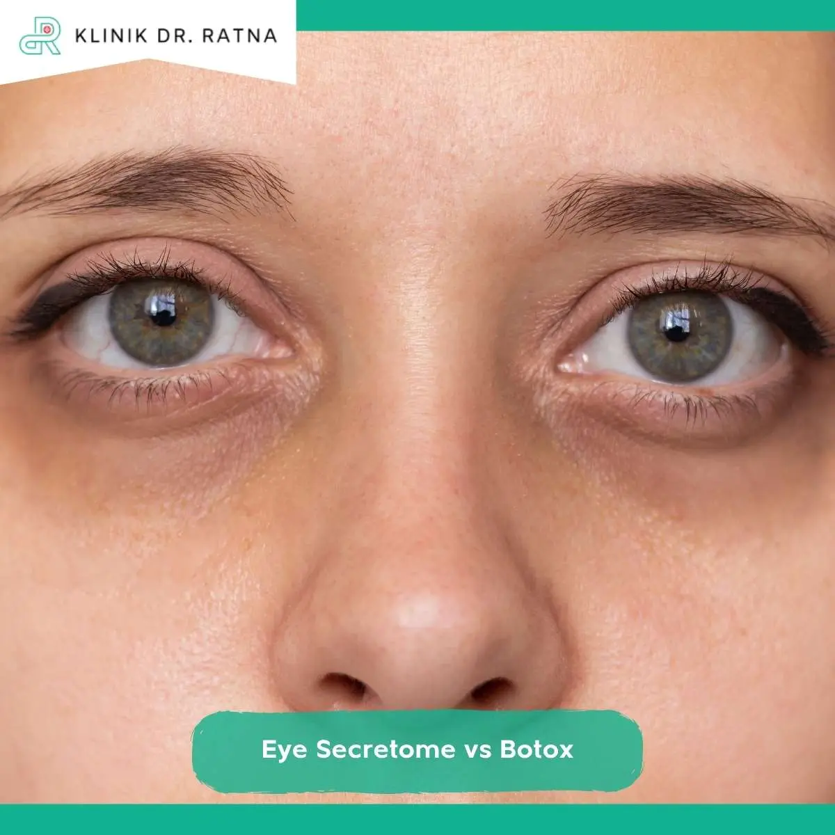 Bisakah Eye Secretome dan Botox Dikombinasikan?