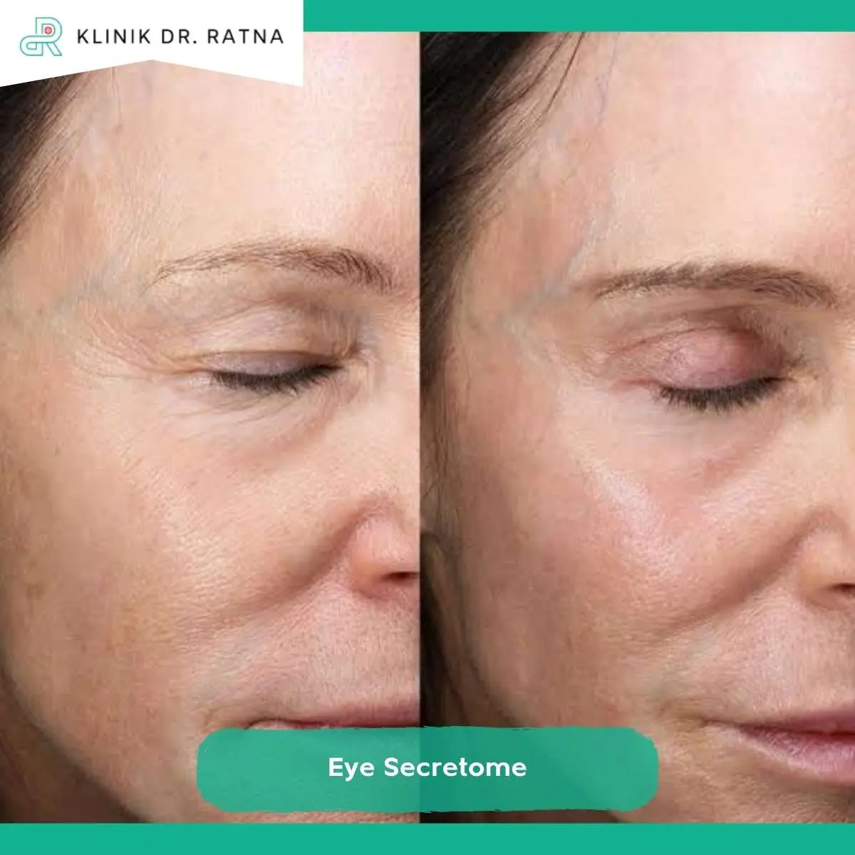 Prosedur Treatment Eye Secretome di Klinik dr Ratna