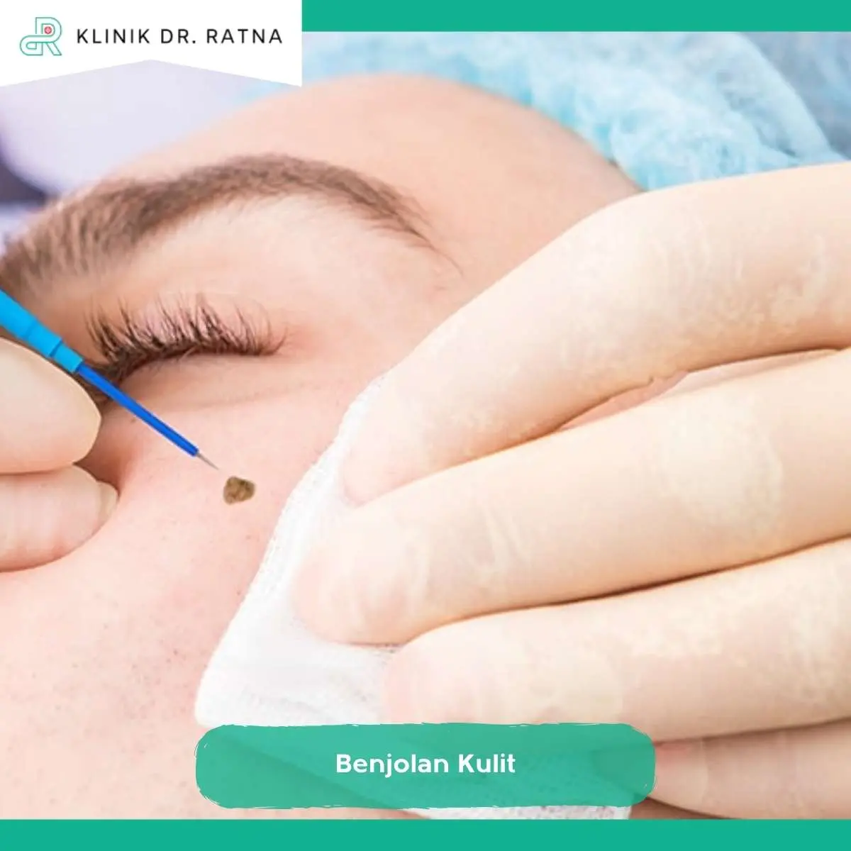 Kenali Jenis Benjolan Kulit yang Perlu Diperiksakan ke Dokter