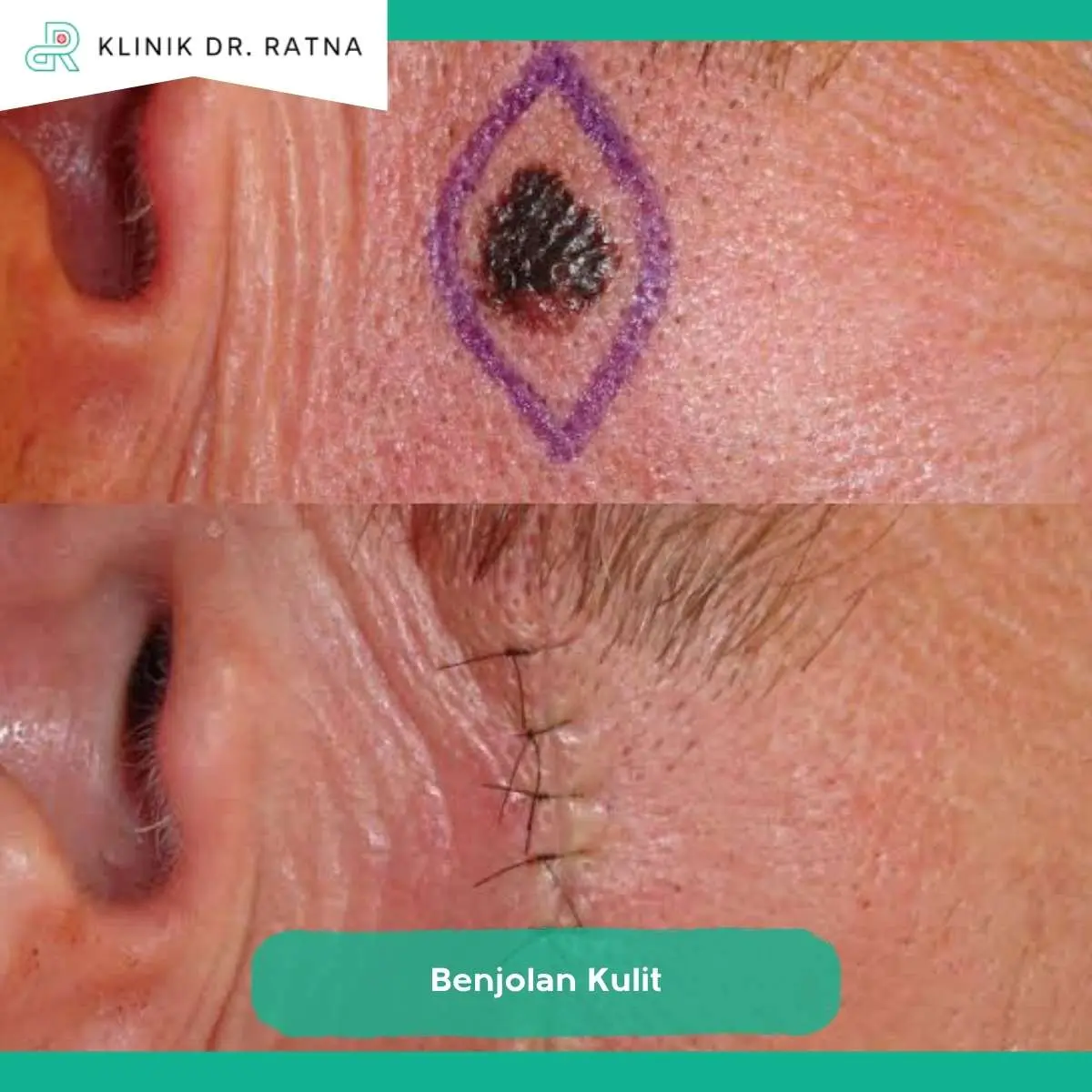 Kapan Benjolan Kulit Sebaiknya Segera Diperiksa?