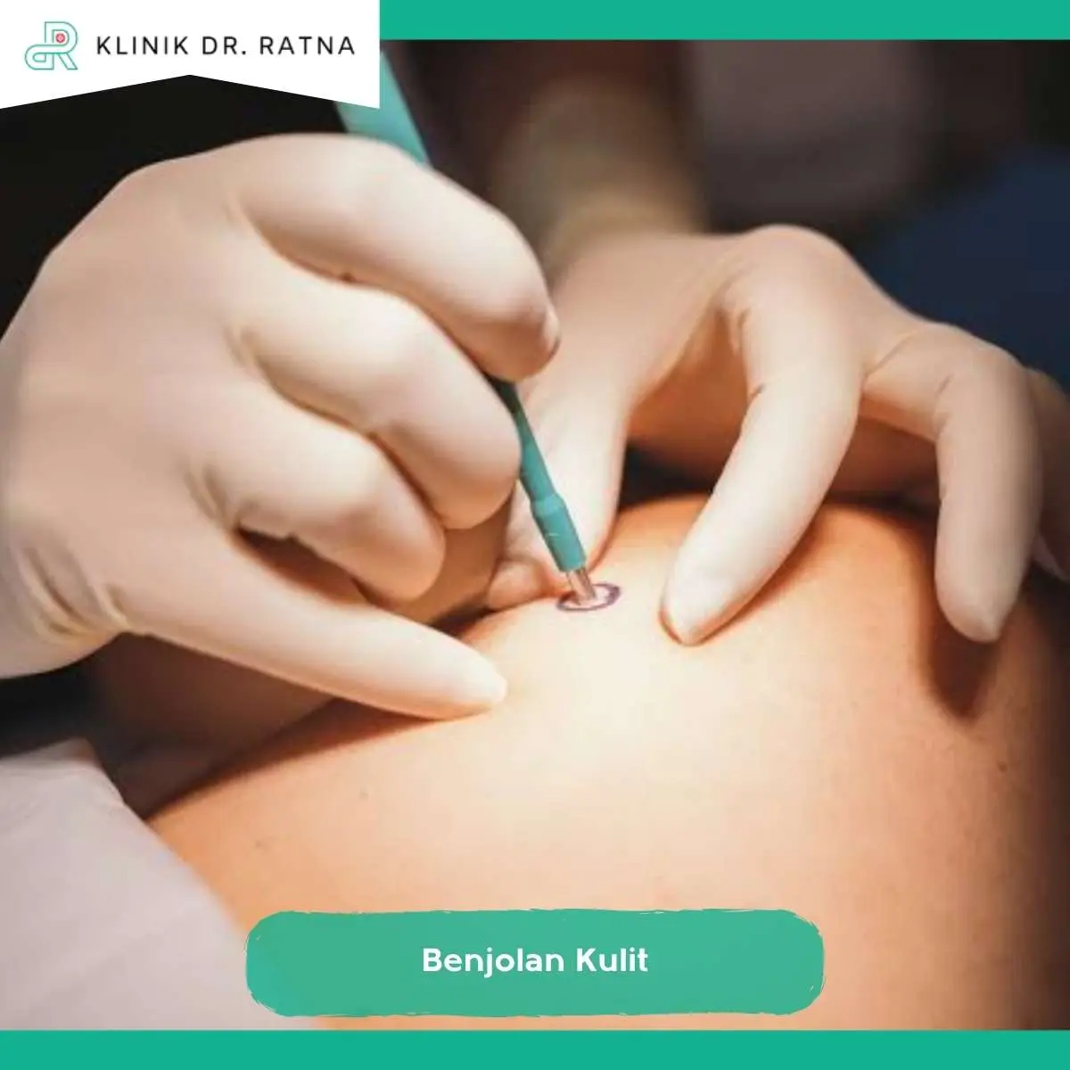 Tahapan Treatment Benjolan Kulit di Klinik dr Ratna Surabaya