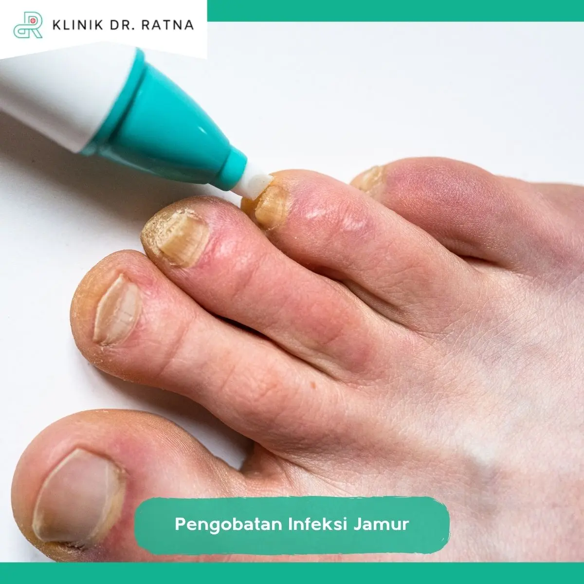 Mengapa Memilih Klinik dr Ratna untuk Pengobatan Jamur Kulit?