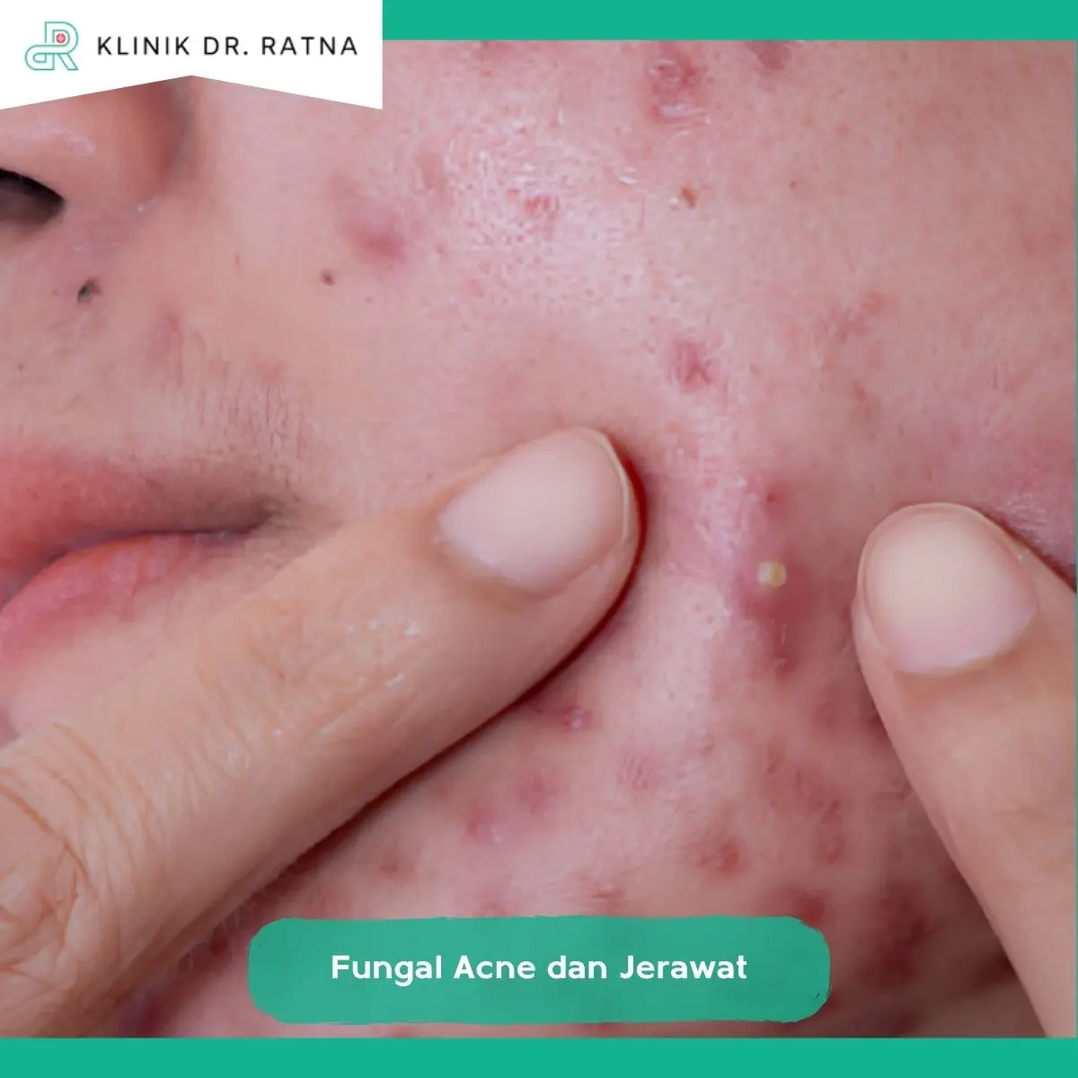 Apakah Perawatan Fungal Acne dan Jerawat Biasa Sama?