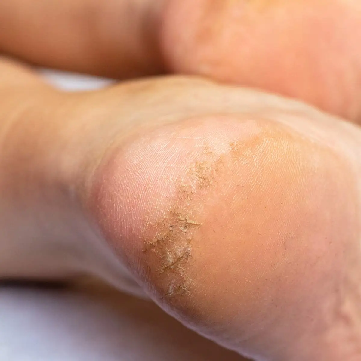 Fungal Infection