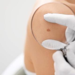 Skin Cancer